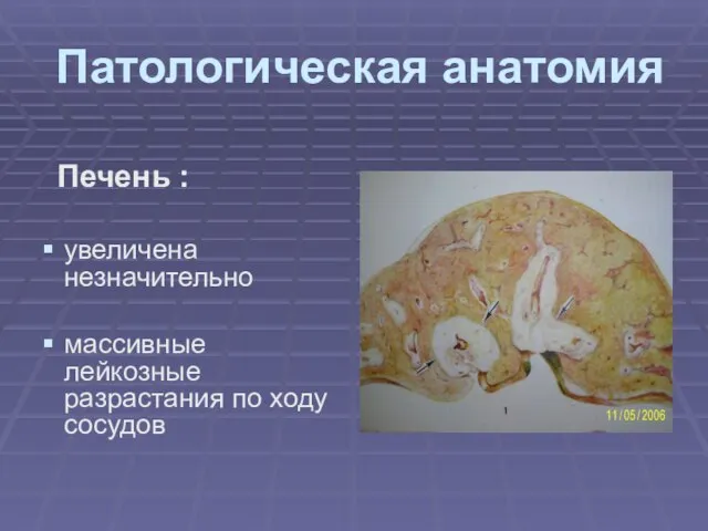 Патологическая анатомия Печень : увеличена незначительно массивные лейкозные разрастания по ходу сосудов