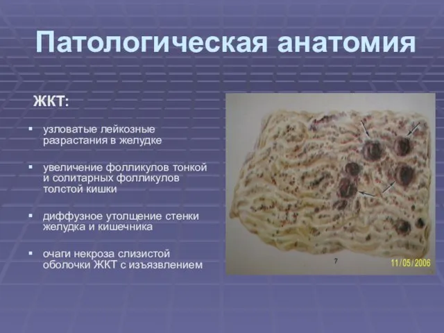 Патологическая анатомия ЖКТ: узловатые лейкозные разрастания в желудке увеличение фолликулов тонкой и