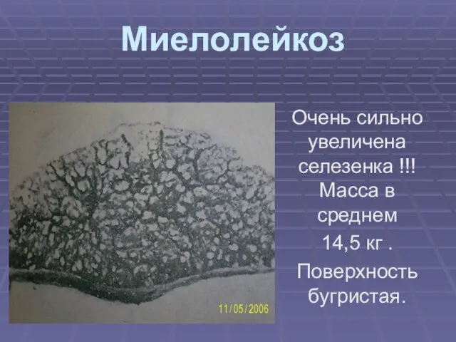 Миелолейкоз Очень сильно увеличена селезенка !!! Масса в среднем 14,5 кг . Поверхность бугристая.