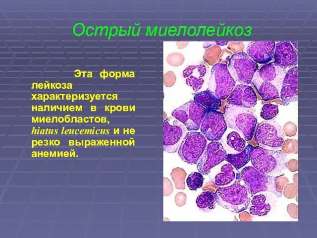 Острый миелолейкоз Эта форма лейкоза характеризуется наличием в крови миелобластов, hiatus leucemicus