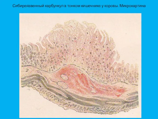 Сибиреязвенный карбункул в тонком кишечнике у коровы. Микрокартина