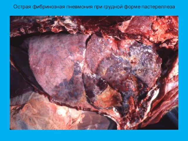 Острая фибринозная пневмония при грудной форме пастереллеза