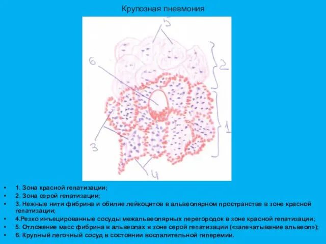 Крупозная пневмония 1. Зона красной гепатизации; 2. Зона серой гепатизации; 3. Нежные