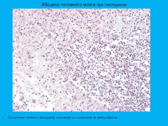 Абсцесс головного мозга при листериозе Скопление гнойного экссудата, состоящего в основном из нейтрофилов