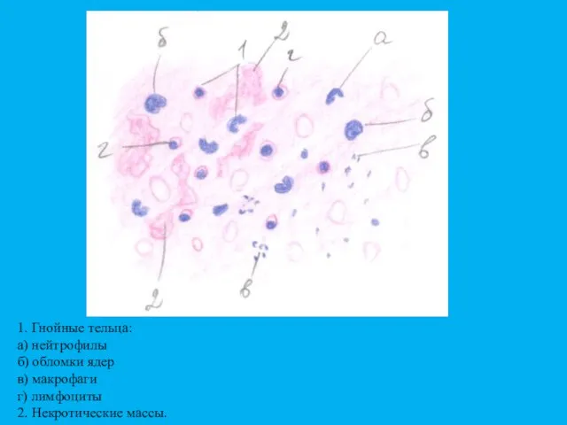 1. Гнойные тельца: а) нейтрофилы б) обломки ядер в) макрофаги г) лимфоциты 2. Некротические массы.