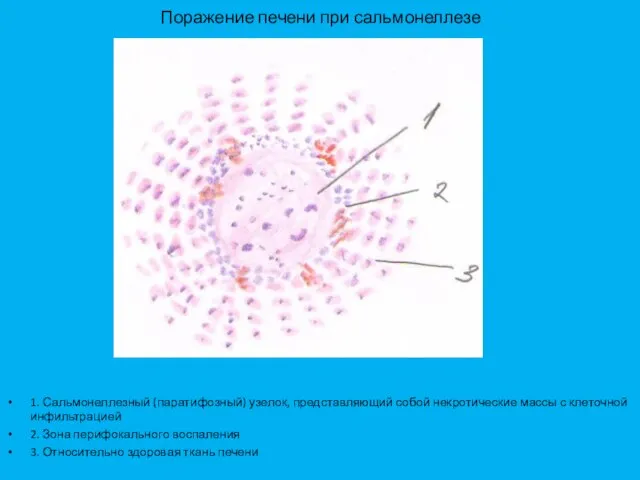 Поражение печени при сальмонеллезе 1. Сальмонеллезный (паратифозный) узелок, представляющий собой некротические массы