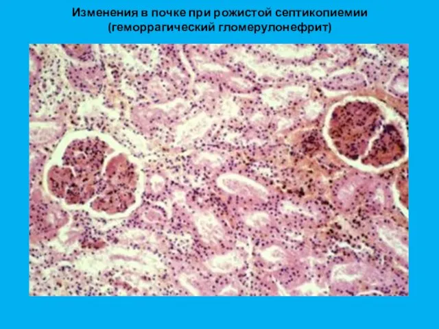 Изменения в почке при рожистой септикопиемии (геморрагический гломерулонефрит)
