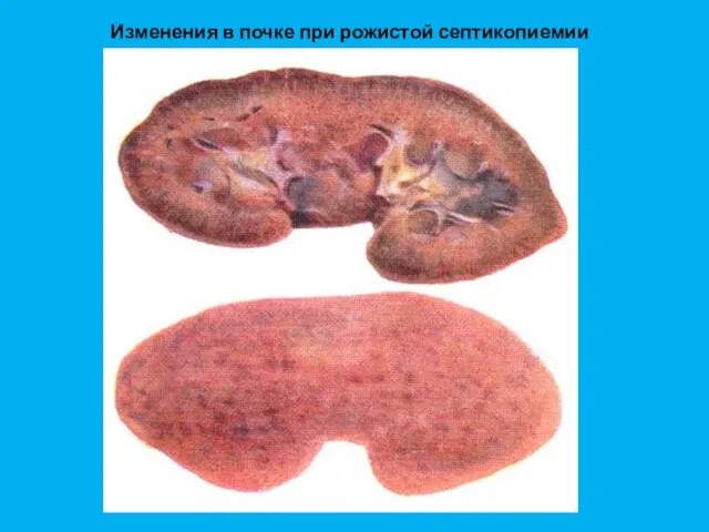 Изменения в почке при рожистой септикопиемии