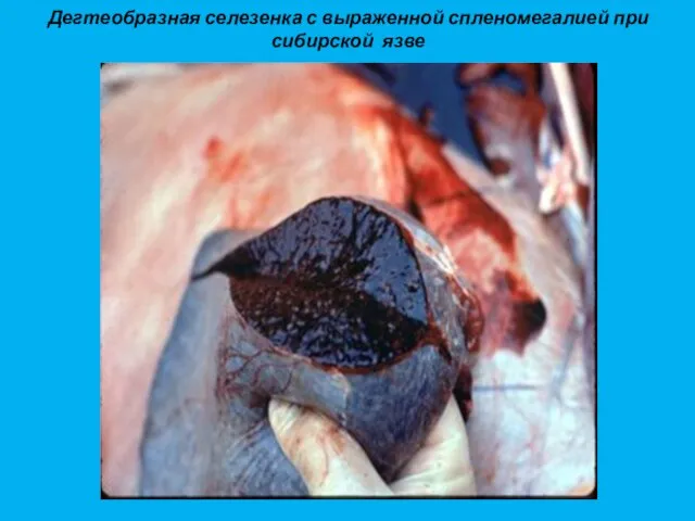 Дегтеобразная селезенка с выраженной спленомегалией при сибирской язве