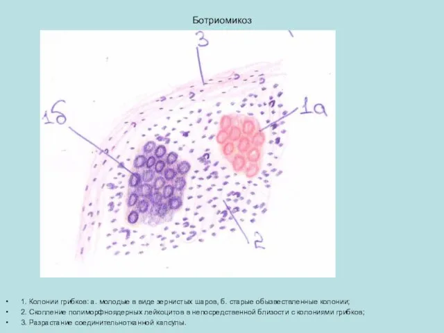 Ботриомикоз 1. Колонии грибков: а. молодые в виде зернистых шаров, б. старые