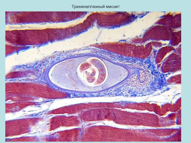 Трихинеллезный миозит