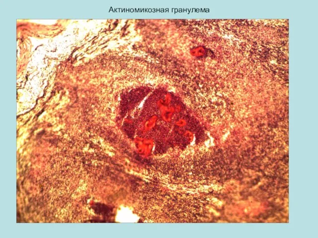 Актиномикозная гранулема