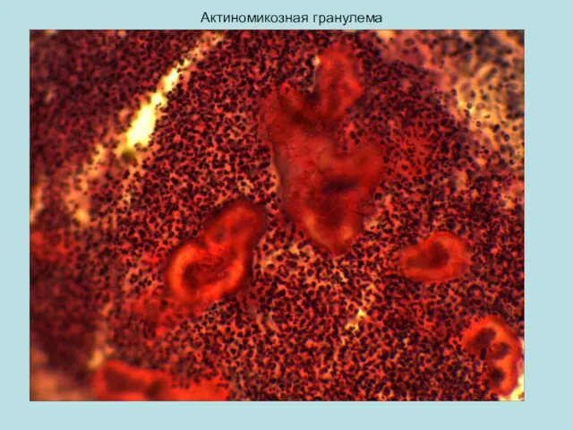 Актиномикозная гранулема