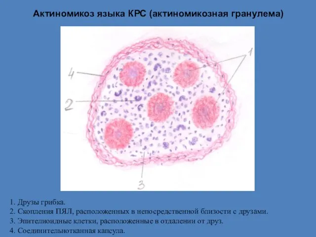 Актиномикоз языка КРС (актиномикозная гранулема) 1. Друзы грибка. 2. Скопления ПЯЛ, расположенных