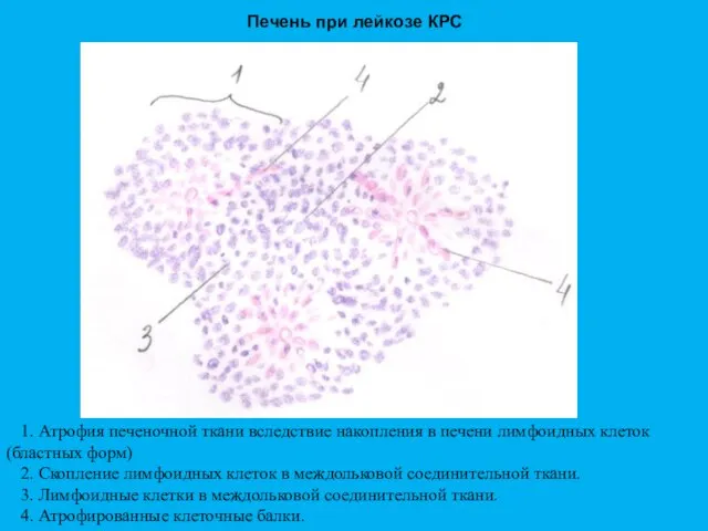 Печень при лейкозе КРС 1. Атрофия печеночной ткани вследствие накопления в печени