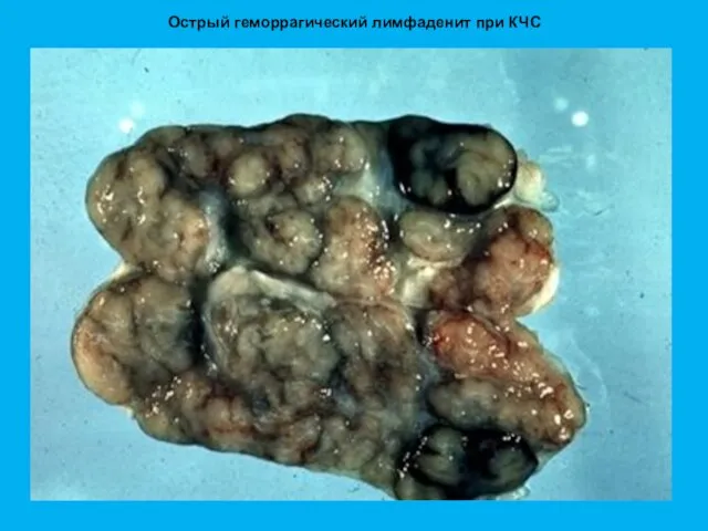 Острый геморрагический лимфаденит при КЧС