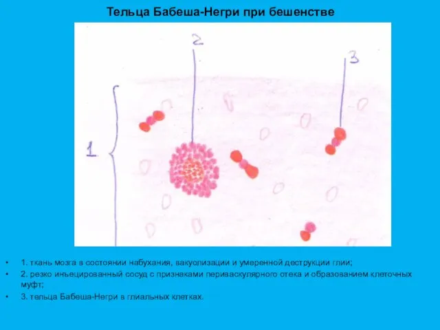 Тельца Бабеша-Негри при бешенстве 1. ткань мозга в состоянии набухания, вакуолизации и