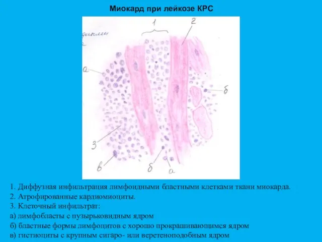 Миокард при лейкозе КРС 1. Диффузная инфильтрация лимфоидными бластными клетками ткани миокарда.