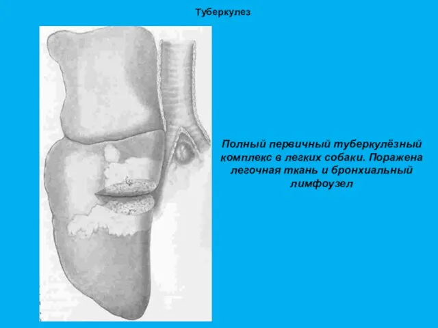 Туберкулез Полный первичный туберкулёзный комплекс в легких собаки. Поражена легочная ткань и бронхиальный лимфоузел
