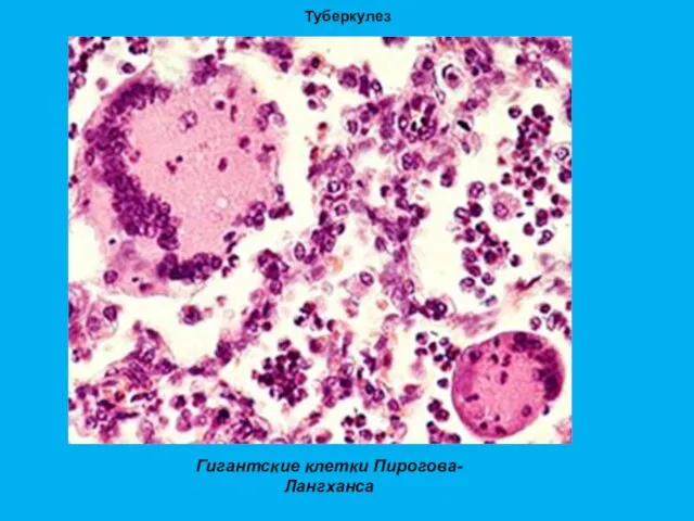 Туберкулез Гигантские клетки Пирогова-Лангханса