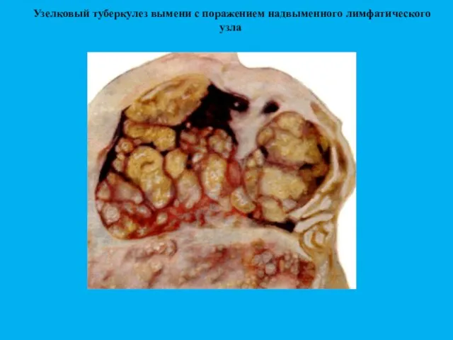 Узелковый туберкулез вымени с поражением надвыменного лимфатического узла