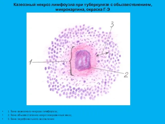 Казеозный некроз лимфоузла при туберкулезе с обызвествлением, микрокартина, окраска Г-Э 1. Зона