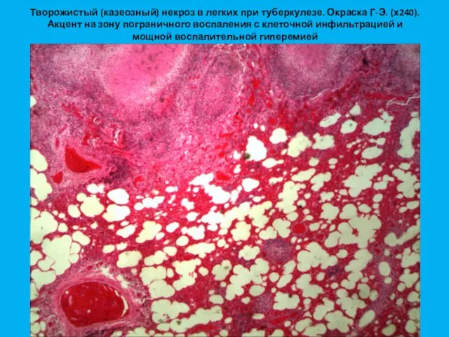 Творожистый (казеозный) некроз в легких при туберкулезе. Окраска Г-Э. (х240). Акцент на