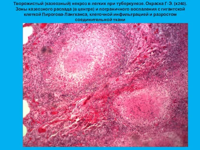 Творожистый (казеозный) некроз в легких при туберкулезе. Окраска Г-Э. (х240). Зоны казеозного