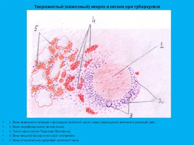 Творожистый (казеозный) некроз в легких при туберкулезе 1. Зона казеозного некроза с