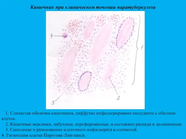 Кишечник при клиническом течении паратуберкулеза 1. Слизистая оболочка кишечника, диффузно инфильтрирована экссудатом