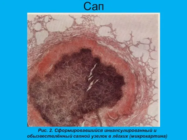 Сап Рис. 2. Сформировавшийся инкапсулированный и обызвествлённый сапной узелок в лёгких (микрокартина)