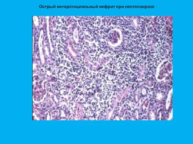 Острый интерстициальный нефрит при лептоспирозе
