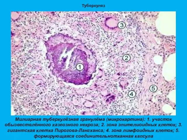 Туберкулез Милиарная туберкулёзная гранулёма (микрокартина): 1. участок обызвествлённого казеозного некроза; 2. зона