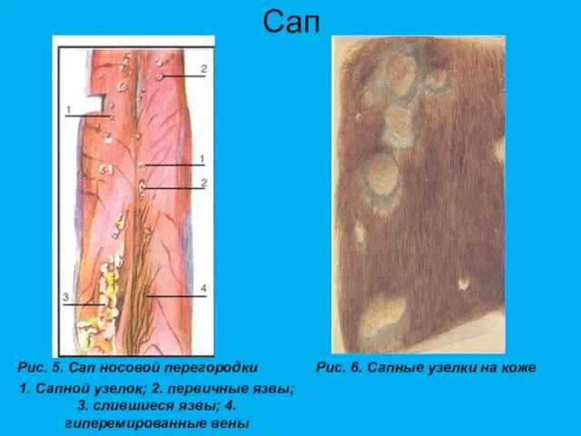 Сап Рис. 5. Сап носовой перегородки 1. Сапной узелок; 2. первичные язвы;