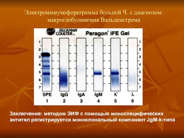 Электроиммунофореграмма больной Ч. с диагнозом: макроглобулинемия Вальденстрема Заключение: методом ЭИФ с помощью