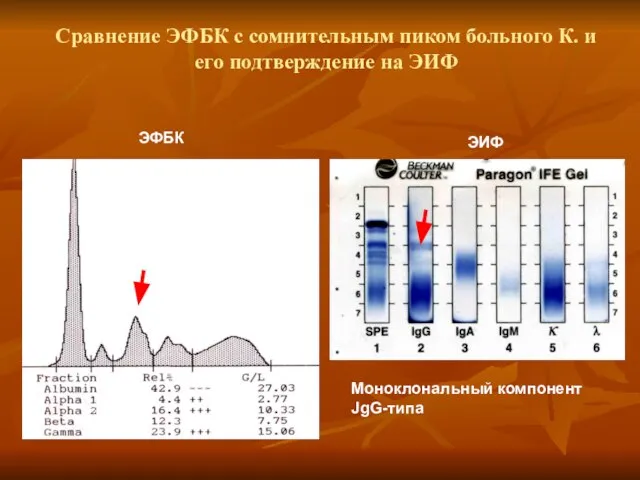 Сравнение ЭФБК с сомнительным пиком больного К. и его подтверждение на ЭИФ