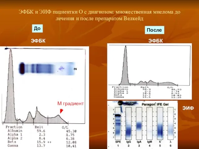 ЭФБК и ЭИФ пациентки О с диагнозом: множественная миелома до лечения и