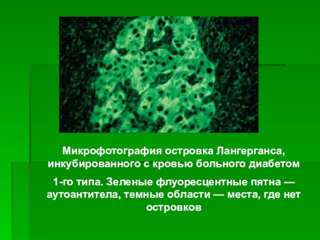 Микрофотография островка Лангерганса, инкубированного с кровью больного диабетом 1-го типа. Зеленые флуоресцентные