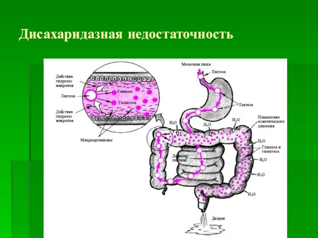 Дисахаридазная недостаточность