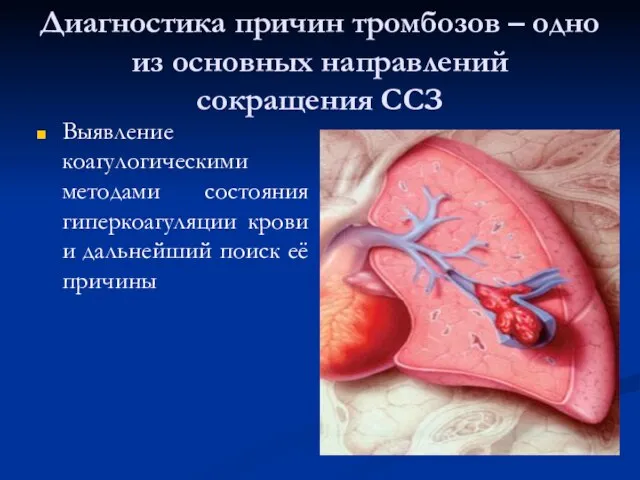 Диагностика причин тромбозов – одно из основных направлений сокращения ССЗ Выявление коагулогическими