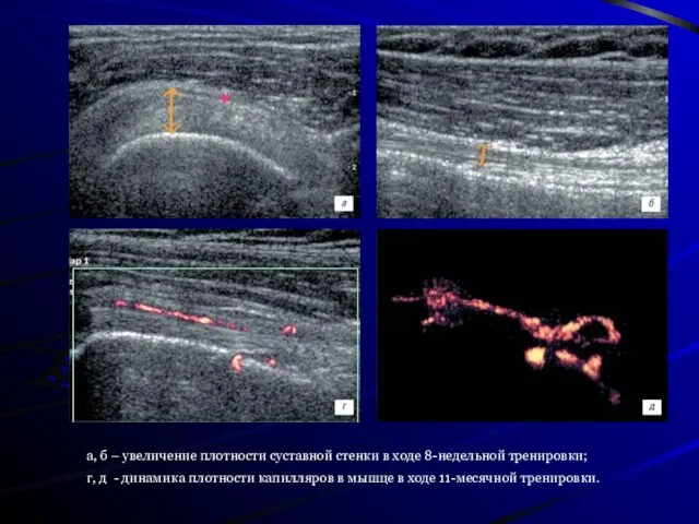 а, б – увеличение плотности суставной стенки в ходе 8-недельной тренировки; г,