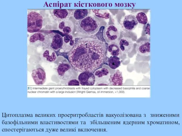 Аспірат кісткового мозку Цитоплазма великих проеритробластів вакуолізована з зниженими базофільними властивостями та