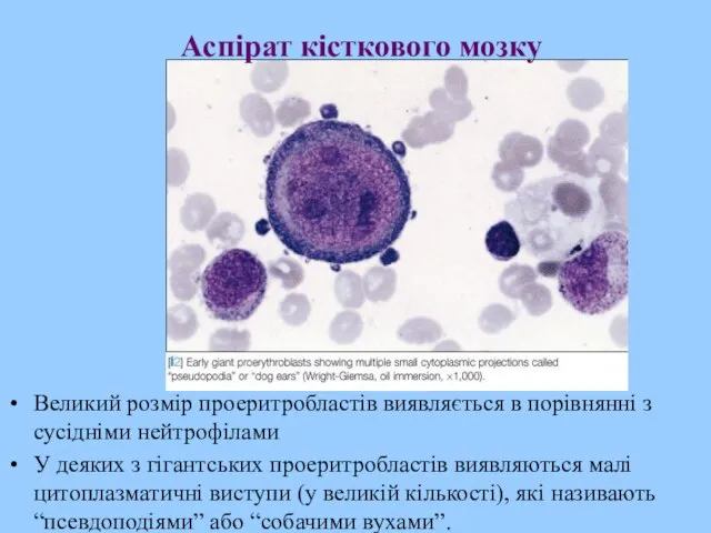 Аспірат кісткового мозку Великий розмір проеритробластів виявляється в порівнянні з сусідніми нейтрофілами