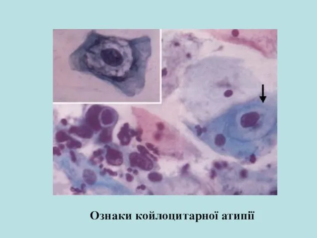 Ознаки койлоцитарної атипії