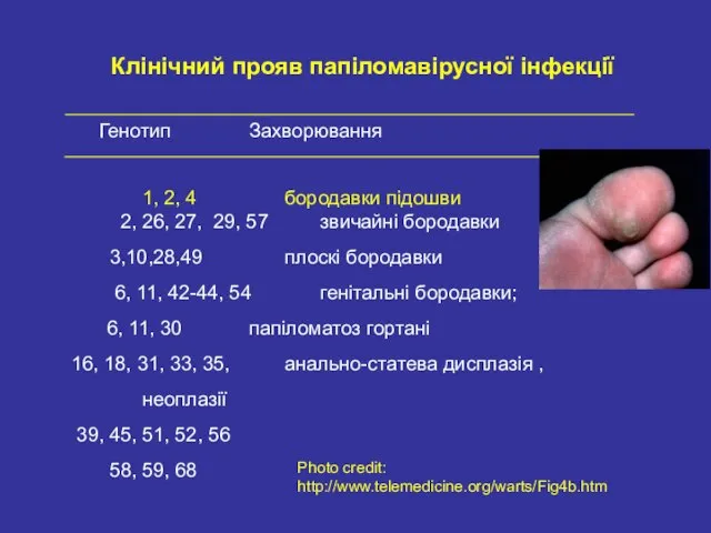 Генотип Захворювання 1, 2, 4 бородавки підошви 2, 26, 27, 29, 57