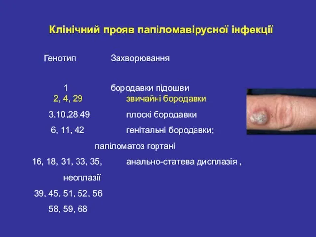 Клінічний прояв папіломавірусної інфекції Генотип Захворювання 1 бородавки підошви 2, 4, 29