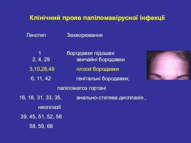 Клінічний прояв папіломавірусної інфекції Генотип Захворювання 1 бородавки підошви 2, 4, 29