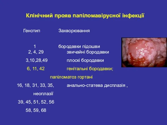 Клінічний прояв папіломавірусної інфекції Генотип Захворювання 1 бородавки підошви 2, 4, 29