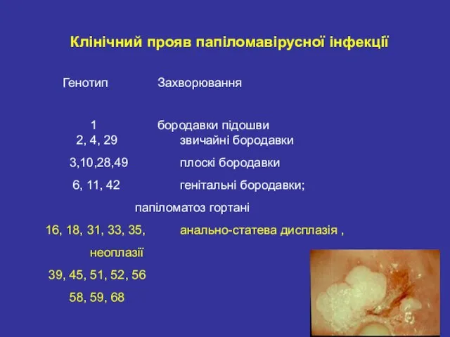 Клінічний прояв папіломавірусної інфекції Генотип Захворювання 1 бородавки підошви 2, 4, 29