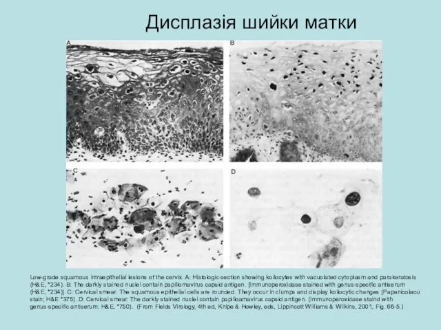 Low-grade squamous intraepithelial lesions of the cervix. A: Histologic section showing koilocytes